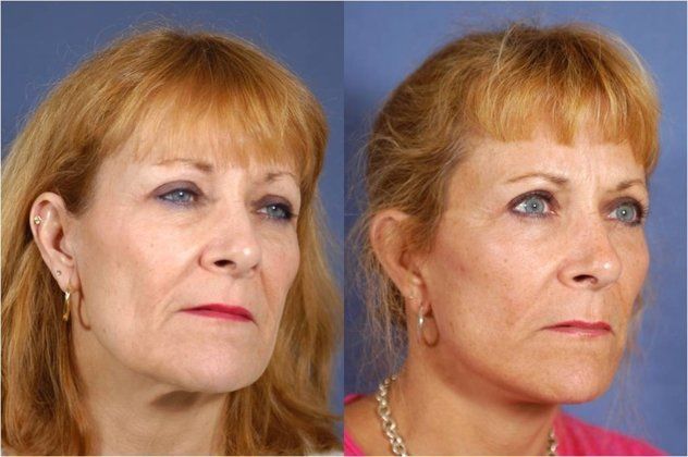 Facelift Patient